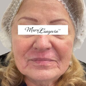 After Image: Dermal Filler